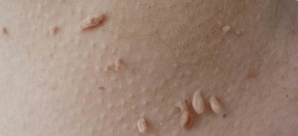 HPV transmission method