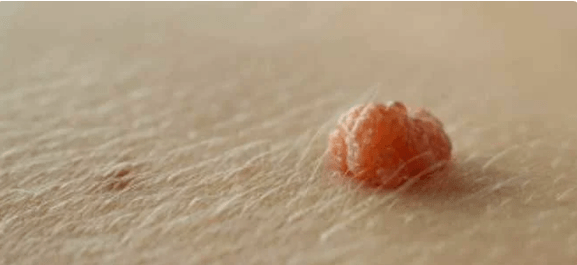 Papilloma virus