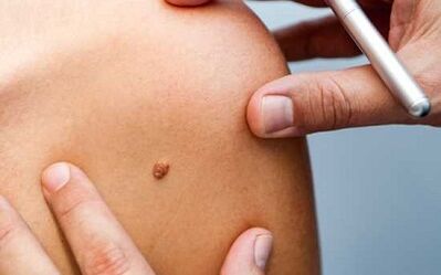 Papilloma treatment methods