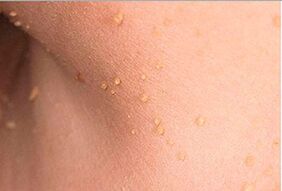 How are papillomas in the body