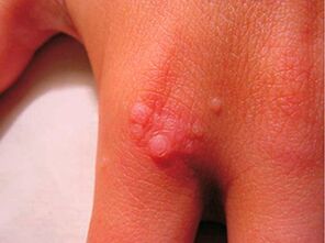 How to get rid of little papillomas