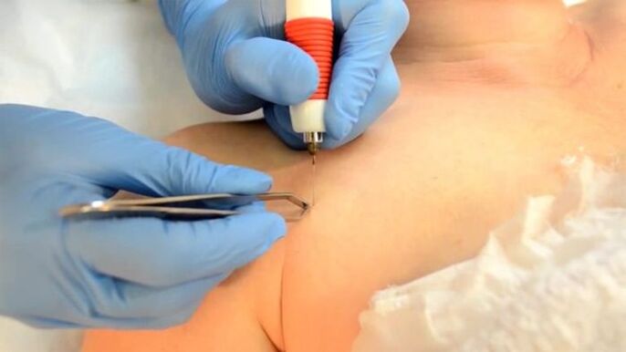 Electrocoagulation a method to eliminate papillomas.