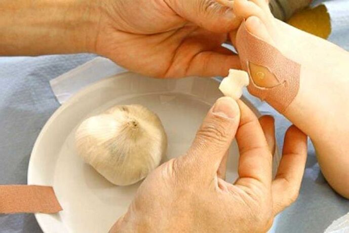 Treatment of papilloma with garlic compress.