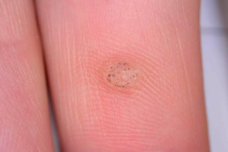 what are warts