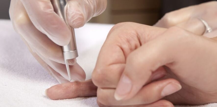 Ways to remove papillomas on the hands and why they are dangerous.