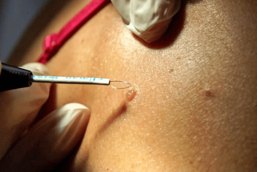 professional methods to remove papillomas.