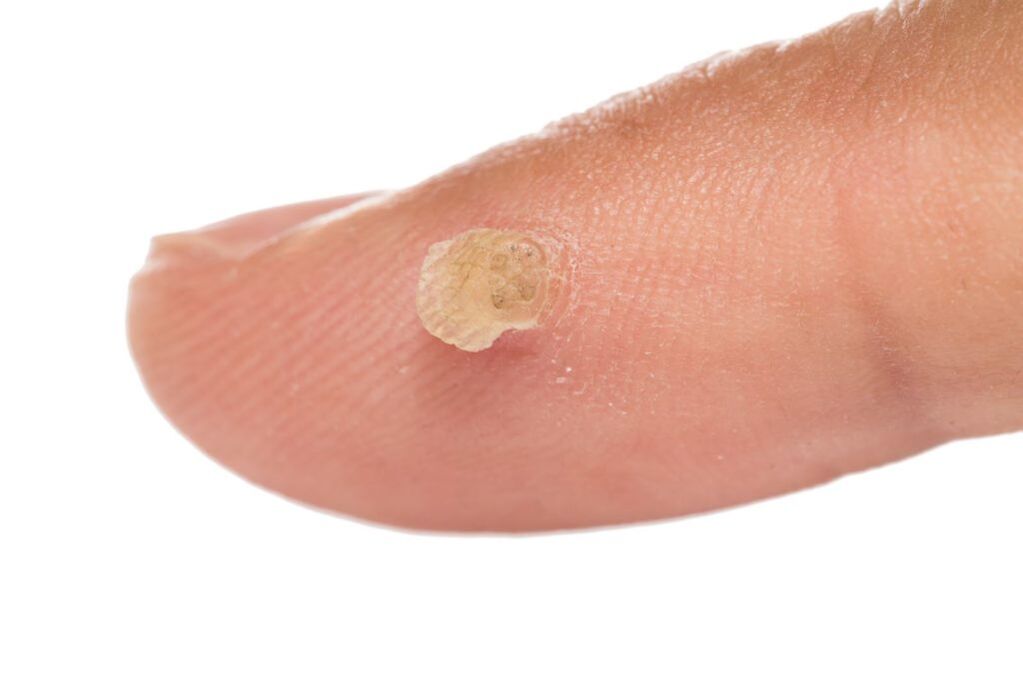 genital wart on finger