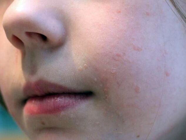 Flat warts on the face appear most frequently during adolescence. 