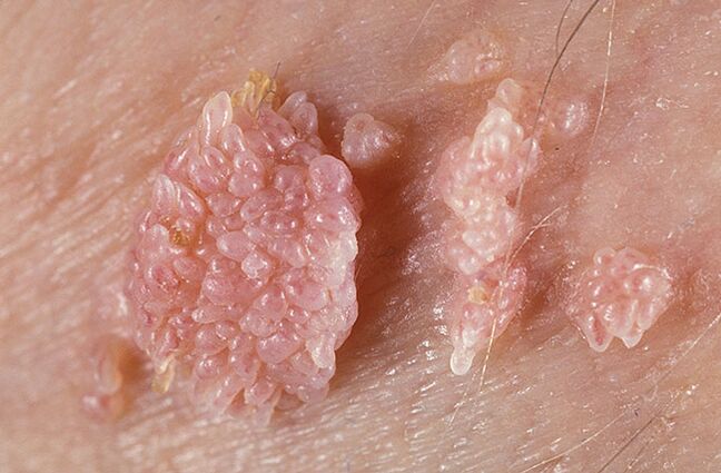 Papilloma is a benign tumor-like formation of the skin and mucous membranes of a warty nature. 
