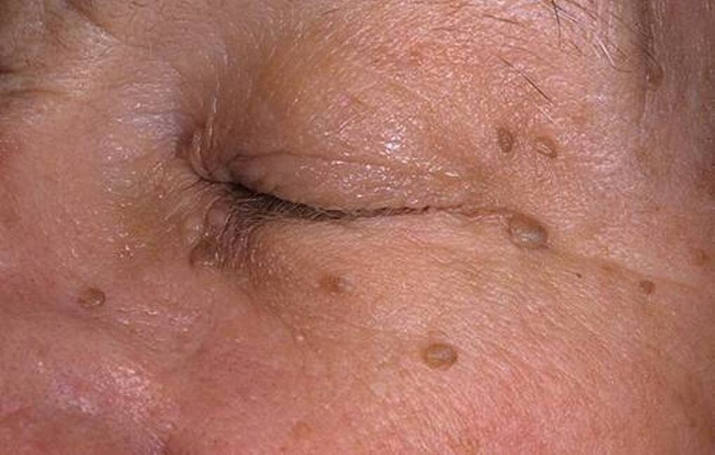 Papillomas on the skin of the face. 